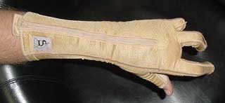 Splint for Amputation